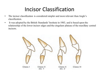 Incisor Classification
• The incisor classification is considered simpler and more relevant than Angle’s
classification.
• It was adopted by the British Standards’Institute in 1983, and is based upon the
relationship of the lower incisor edges and the cingulum plateau of the maxillary central
incisors.
 
