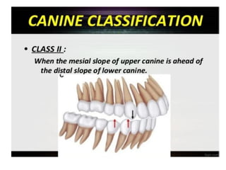 update Classification of Malocclusion- updated.pdf