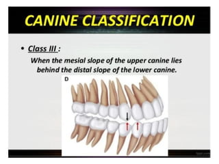 update Classification of Malocclusion- updated.pdf