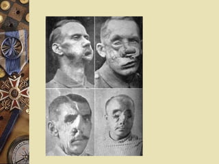 Verdun – February, 1916 German offensive. Each side had 500,000 casualties. 