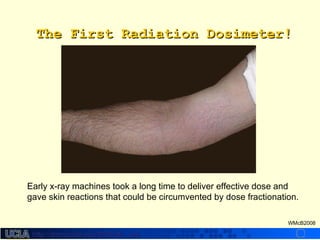 http://dmco.ucla.edu/McBride_Labhttp://dmco.ucla.edu/McBride_Lab
WMcB2008
The First Radiation Dosimeter!The First Radiation Dosimeter!
Early x-ray machines took a long time to deliver effective dose and
gave skin reactions that could be circumvented by dose fractionation.
 