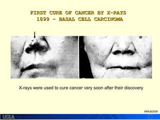 http://dmco.ucla.edu/McBride_Labhttp://dmco.ucla.edu/McBride_Lab
WMcB2008
FIRST CURE OF CANCER BY X-RAYSFIRST CURE OF CANCER BY X-RAYS
1899 - BASAL CELL CARCINOMA1899 - BASAL CELL CARCINOMA
X-rays were used to cure cancer very soon after their discovery
 