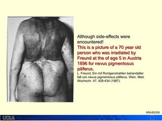 http://dmco.ucla.edu/McBride_Labhttp://dmco.ucla.edu/McBride_Lab
WMcB2008
Although side-effects wereAlthough side-effects were
encountered!encountered!
This is a picture of a 70 year oldThis is a picture of a 70 year old
person who was irradiated byperson who was irradiated by
Freund at the of age 5 in AustriaFreund at the of age 5 in Austria
1896 for nevus pigmentosus1896 for nevus pigmentosus
piliferus.piliferus.
L. Freund, Ein mit Rontgenstrahlen behandelterL. Freund, Ein mit Rontgenstrahlen behandelter
fall von nevus pigmentosus piliferus. Wein. Med.fall von nevus pigmentosus piliferus. Wein. Med.
Wochschr. 47, 428-434 (1987).Wochschr. 47, 428-434 (1987).
 
