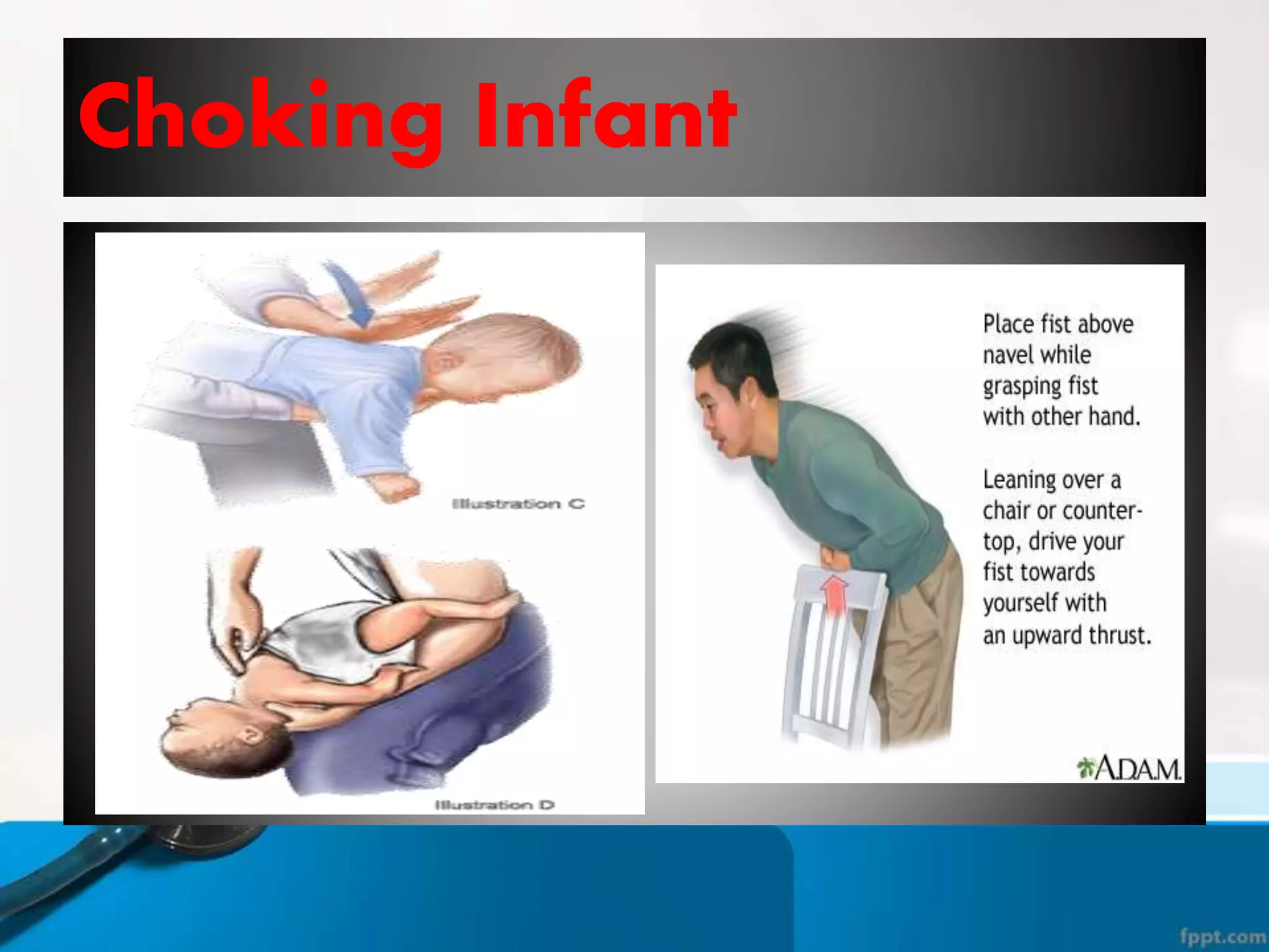 Choking Infant
 