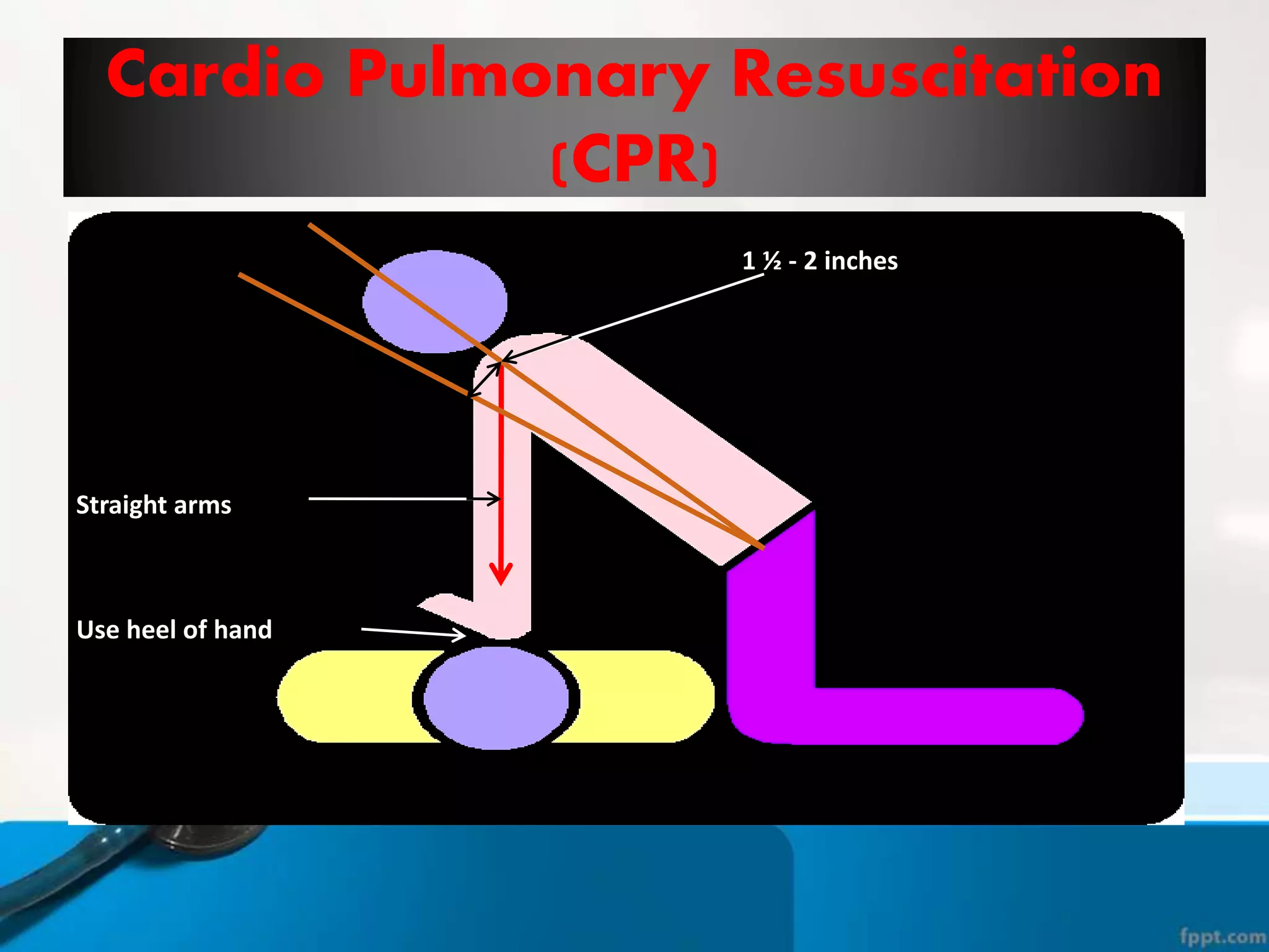 Cardio Pulmonary Resuscitation
(CPR)
Use heel of hand
Straight arms
1 ½ - 2 inches
 