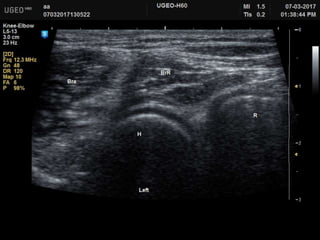 Updated Elbow Musculoskeletal US Examination | PPTX