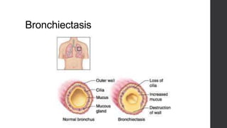 Bronchiectasis
 