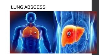 LUNG ABSCESS
 