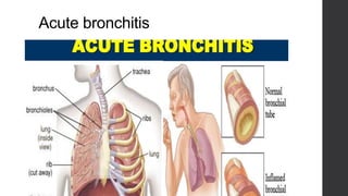 Acute bronchitis
 