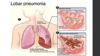 Lobar pneumonia
 