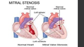 MITRAL STENOSIS
 