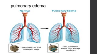 pulmonary edema
 