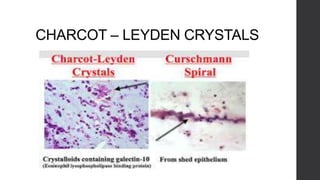 CHARCOT – LEYDEN CRYSTALS
 