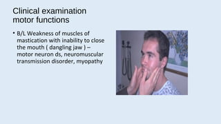 trigeminal neuralgia