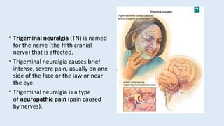 trigeminal neuralgia