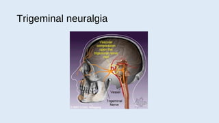 trigeminal neuralgia