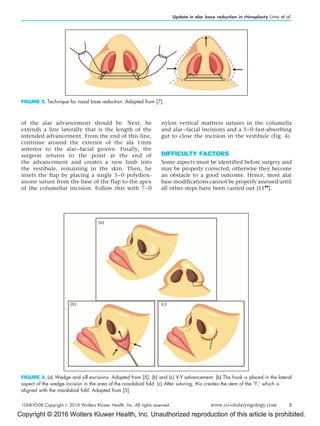 Update in alar base reduction in rhinoplasty | PDF