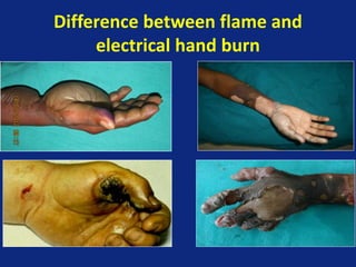 Difference between flame and
electrical hand burn
 