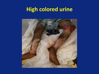 High colored urine
 