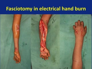 Fasciotomy in electrical hand burn
 