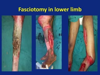 Fasciotomy in lower limb
 