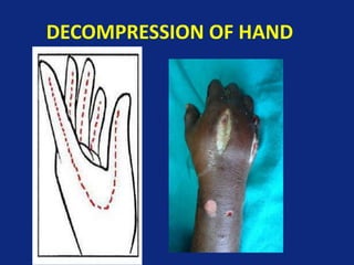 DECOMPRESSION OF HAND
 