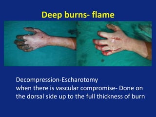 Deep burns- flame
Decompression-Escharotomy
when there is vascular compromise- Done on
the dorsal side up to the full thickness of burn
 