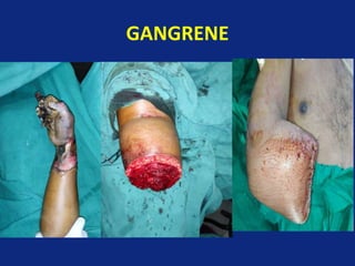 GANGRENE
 
