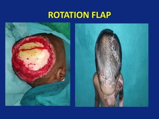 ROTATION FLAP
 