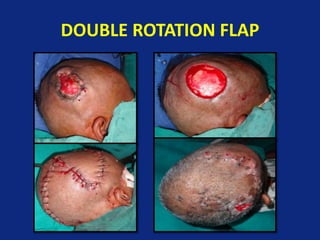 DOUBLE ROTATION FLAP
 