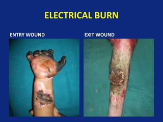ELECTRICAL BURN
ENTRY WOUND EXIT WOUND
 