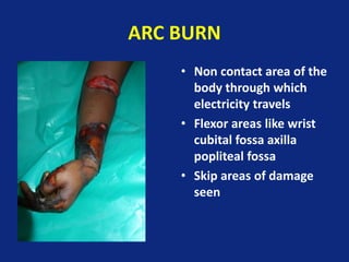 ARC BURN
• Non contact area of the
body through which
electricity travels
• Flexor areas like wrist
cubital fossa axilla
popliteal fossa
• Skip areas of damage
seen
 