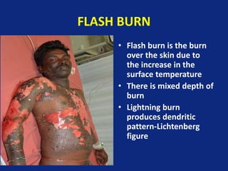 FLASH BURN
• Flash burn is the burn
over the skin due to
the increase in the
surface temperature
• There is mixed depth of
burn
• Lightning burn
produces dendritic
pattern-Lichtenberg
figure
 