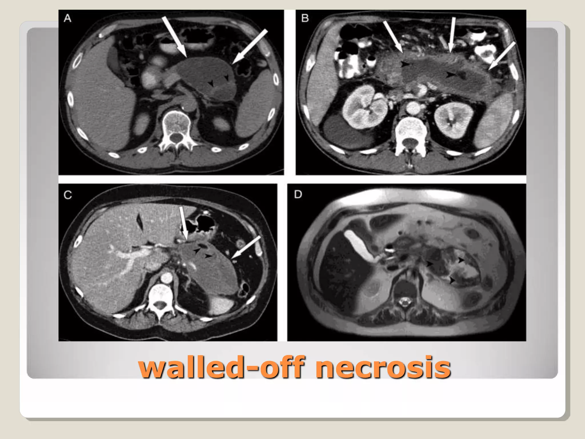 Update of atlanta classification of acute pancreatitis published | PPTX
