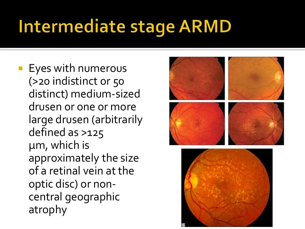 Macular Degeneration Update on clinical trial results and new treat…