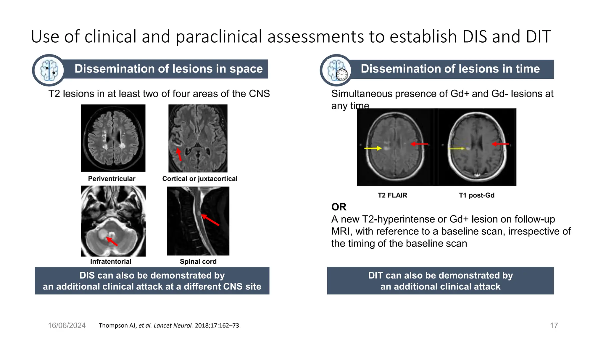16/06/2024 17
Use of clinical and paraclinical assessments to establish DIS and DIT
Thompson AJ, et al. Lancet Neurol. 2018;17:162–73.
Dissemination of lesions in space
T2 lesions in at least two of four areas of the CNS
Periventricular Cortical or juxtacortical
Infratentorial Spinal cord
DIS can also be demonstrated by
an additional clinical attack at a different CNS site
Dissemination of lesions in time
Simultaneous presence of Gd+ and Gd- lesions at
any time
OR
A new T2-hyperintense or Gd+ lesion on follow-up
MRI, with reference to a baseline scan, irrespective of
the timing of the baseline scan
T2 FLAIR T1 post-Gd
DIT can also be demonstrated by
an additional clinical attack
 