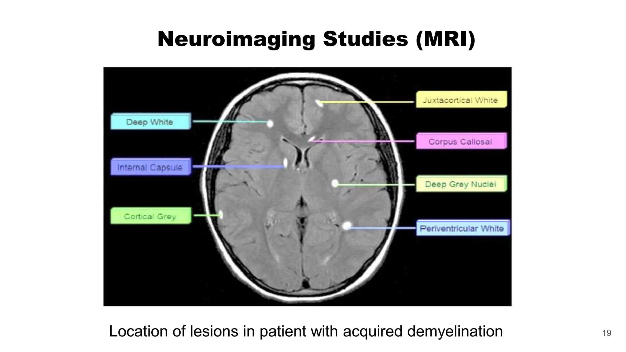 19
Neuroimaging Studies (MRI)
Location of lesions in patient with acquired demyelination
 