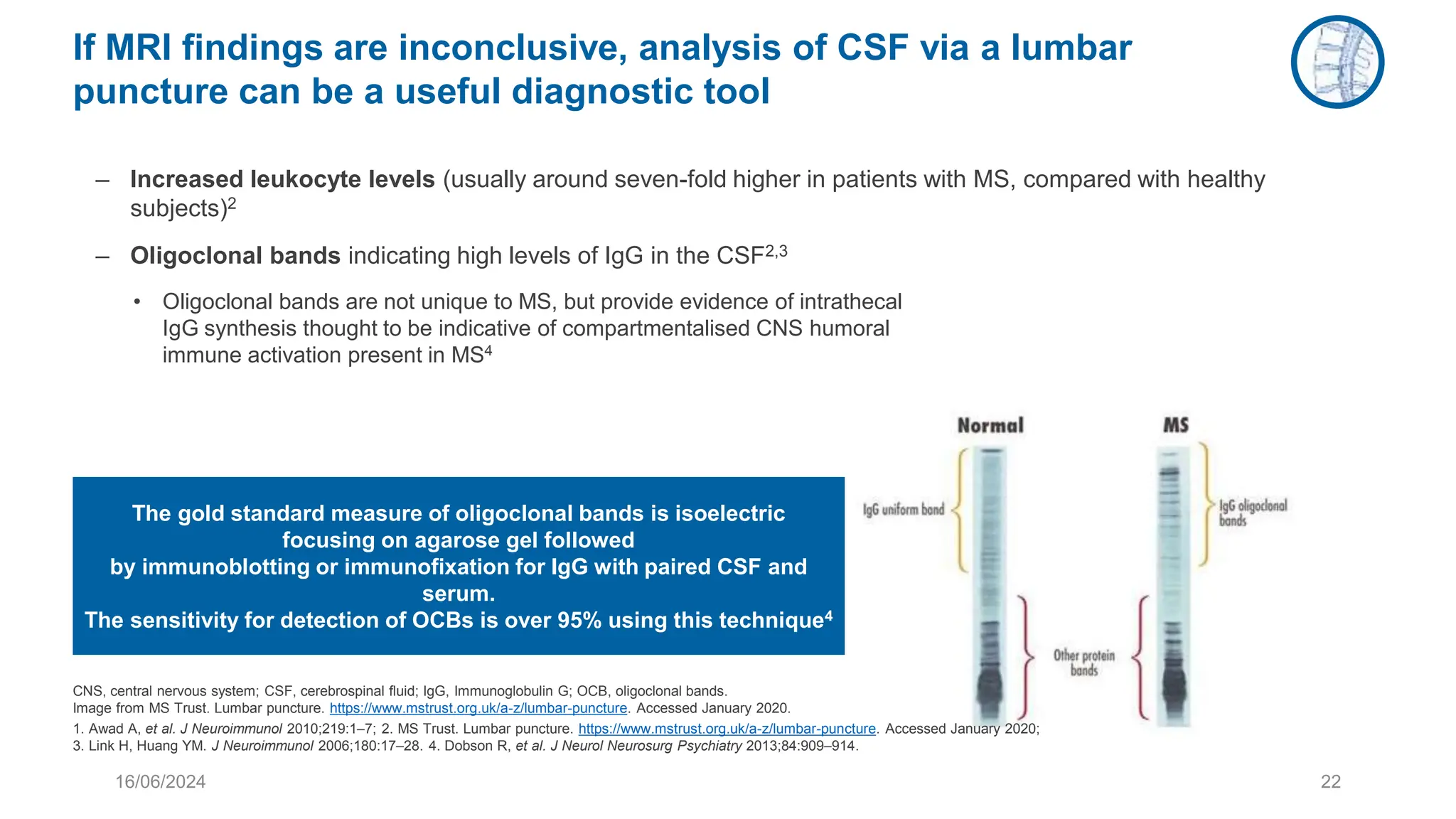 16/06/2024 22
If MRI findings are inconclusive, analysis of CSF via a lumbar
puncture can be a useful diagnostic tool
– Increased leukocyte levels (usually around seven-fold higher in patients with MS, compared with healthy
subjects)2
– Oligoclonal bands indicating high levels of IgG in the CSF2,3
• Oligoclonal bands are not unique to MS, but provide evidence of intrathecal
IgG synthesis thought to be indicative of compartmentalised CNS humoral
immune activation present in MS4
The gold standard measure of oligoclonal bands is isoelectric
focusing on agarose gel followed
by immunoblotting or immunofixation for IgG with paired CSF and
serum.
The sensitivity for detection of OCBs is over 95% using this technique4
CNS, central nervous system; CSF, cerebrospinal fluid; IgG, Immunoglobulin G; OCB, oligoclonal bands.
Image from MS Trust. Lumbar puncture. https://www.mstrust.org.uk/a-z/lumbar-puncture. Accessed January 2020.
1. Awad A, et al. J Neuroimmunol 2010;219:1–7; 2. MS Trust. Lumbar puncture. https://www.mstrust.org.uk/a-z/lumbar-puncture. Accessed January 2020;
3. Link H, Huang YM. J Neuroimmunol 2006;180:17–28. 4. Dobson R, et al. J Neurol Neurosurg Psychiatry 2013;84:909–914.
 