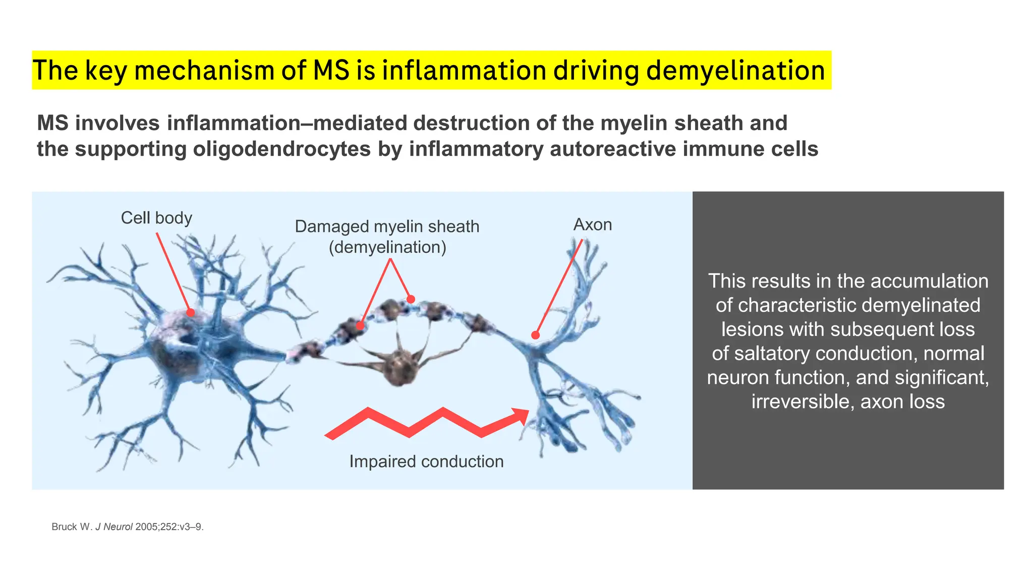 The key mechanism of MS is inflammation driving demyelination
Bruck W. J Neurol 2005;252:v3–9.
Damaged myelin sheath
(demyelination)
Impaired conduction
Cell body Axon
MS involves inflammation–mediated destruction of the myelin sheath and
the supporting oligodendrocytes by inflammatory autoreactive immune cells
This results in the accumulation
of characteristic demyelinated
lesions with subsequent loss
of saltatory conduction, normal
neuron function, and significant,
irreversible, axon loss
 
