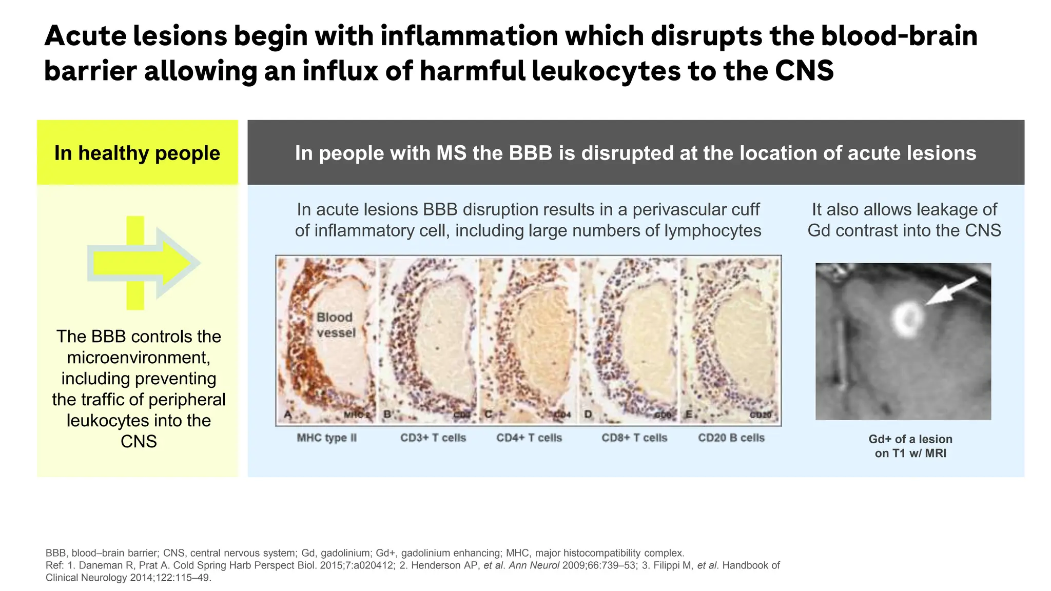 Acute lesions begin with inflammation which disrupts the blood-brain
barrier allowing an influx of harmful leukocytes to the CNS
BBB, blood–brain barrier; CNS, central nervous system; Gd, gadolinium; Gd+, gadolinium enhancing; MHC, major histocompatibility complex.
Ref: 1. Daneman R, Prat A. Cold Spring Harb Perspect Biol. 2015;7:a020412; 2. Henderson AP, et al. Ann Neurol 2009;66:739–53; 3. Filippi M, et al. Handbook of
Clinical Neurology 2014;122:115–49.
In healthy people
The BBB controls the
microenvironment,
including preventing
the traffic of peripheral
leukocytes into the
CNS
In people with MS the BBB is disrupted at the location of acute lesions
Gd+ of a lesion
on T1 w/ MRI
In acute lesions BBB disruption results in a perivascular cuff
of inflammatory cell, including large numbers of lymphocytes
It also allows leakage of
Gd contrast into the CNS
 