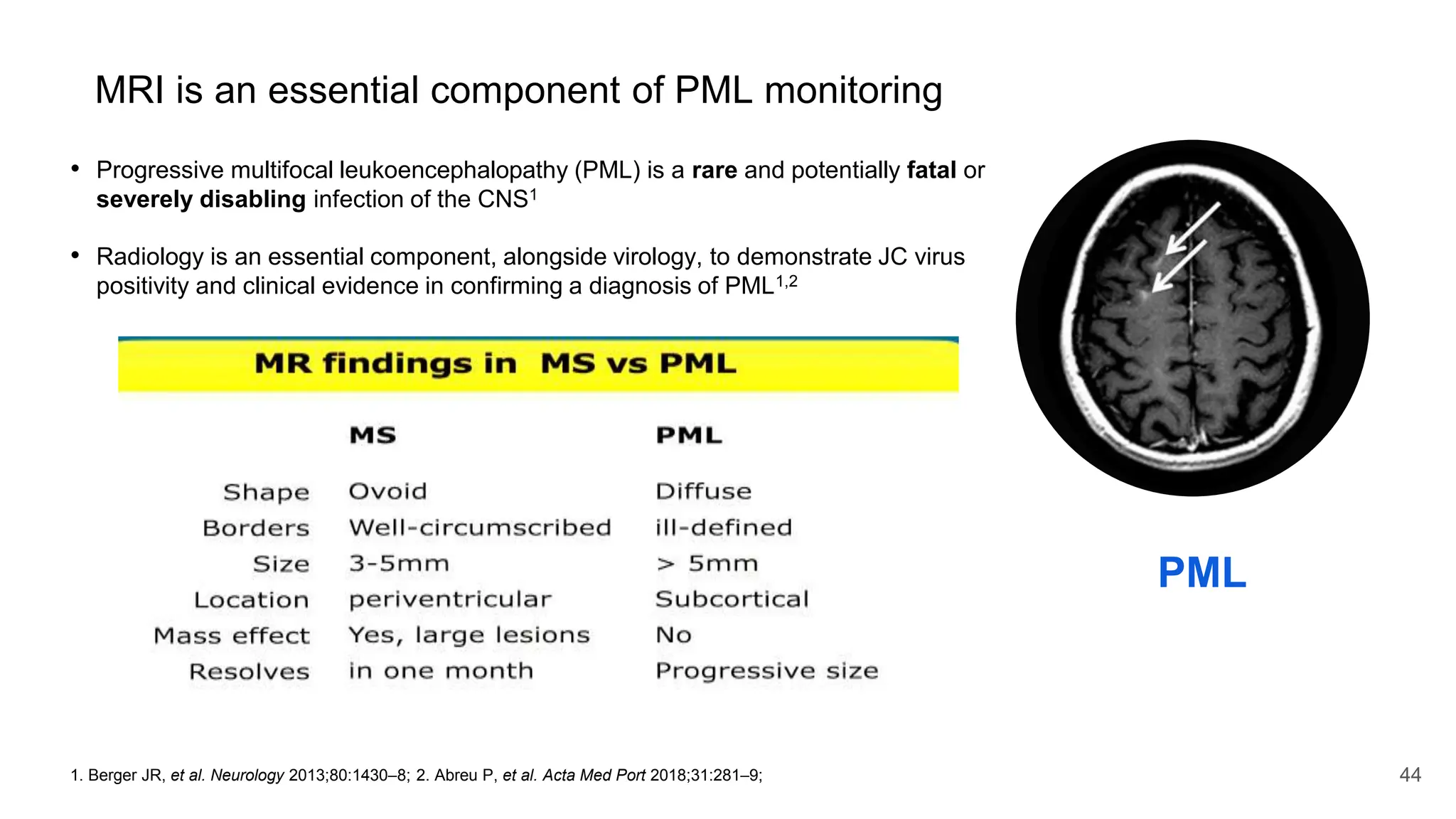 44
MRI is an essential component of PML monitoring
• Progressive multifocal leukoencephalopathy (PML) is a rare and potentially fatal or
severely disabling infection of the CNS1
• Radiology is an essential component, alongside virology, to demonstrate JC virus
positivity and clinical evidence in confirming a diagnosis of PML1,2
1. Berger JR, et al. Neurology 2013;80:1430–8; 2. Abreu P, et al. Acta Med Port 2018;31:281–9;
PML
 