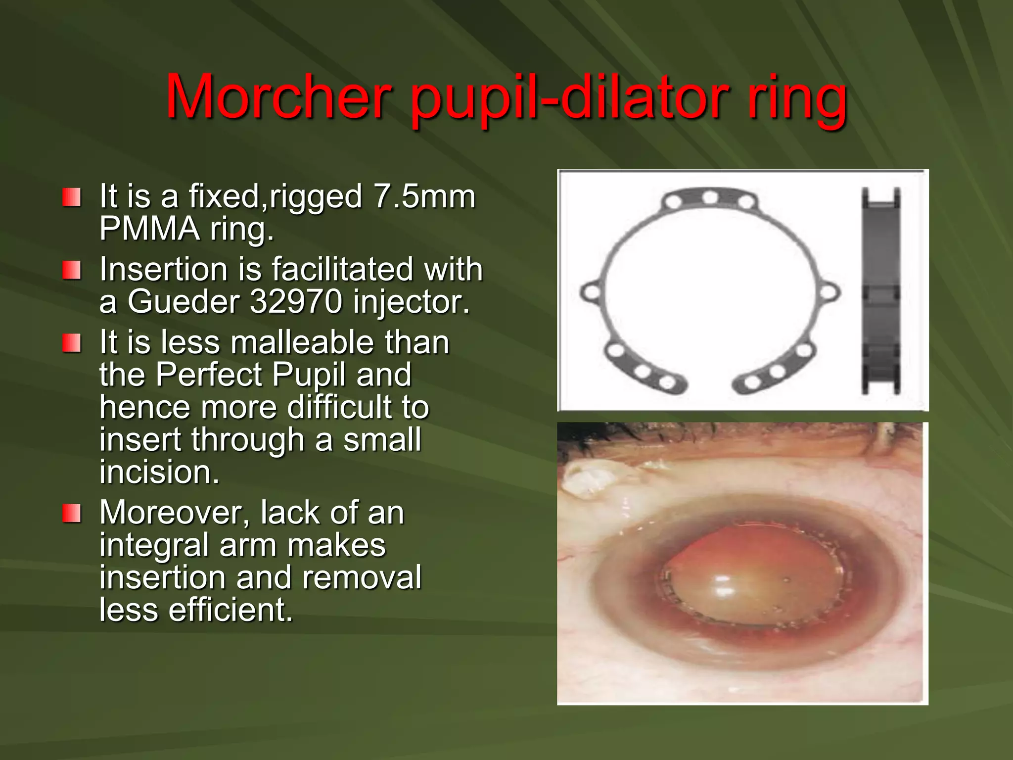 Morcher pupil-dilator ring
It is a fixed,rigged 7.5mm
PMMA ring.
Insertion is facilitated with
a Gueder 32970 injector.
It is less malleable than
the Perfect Pupil and
hence more difficult to
insert through a small
incision.
Moreover, lack of an
integral arm makes
insertion and removal
less efficient.
 