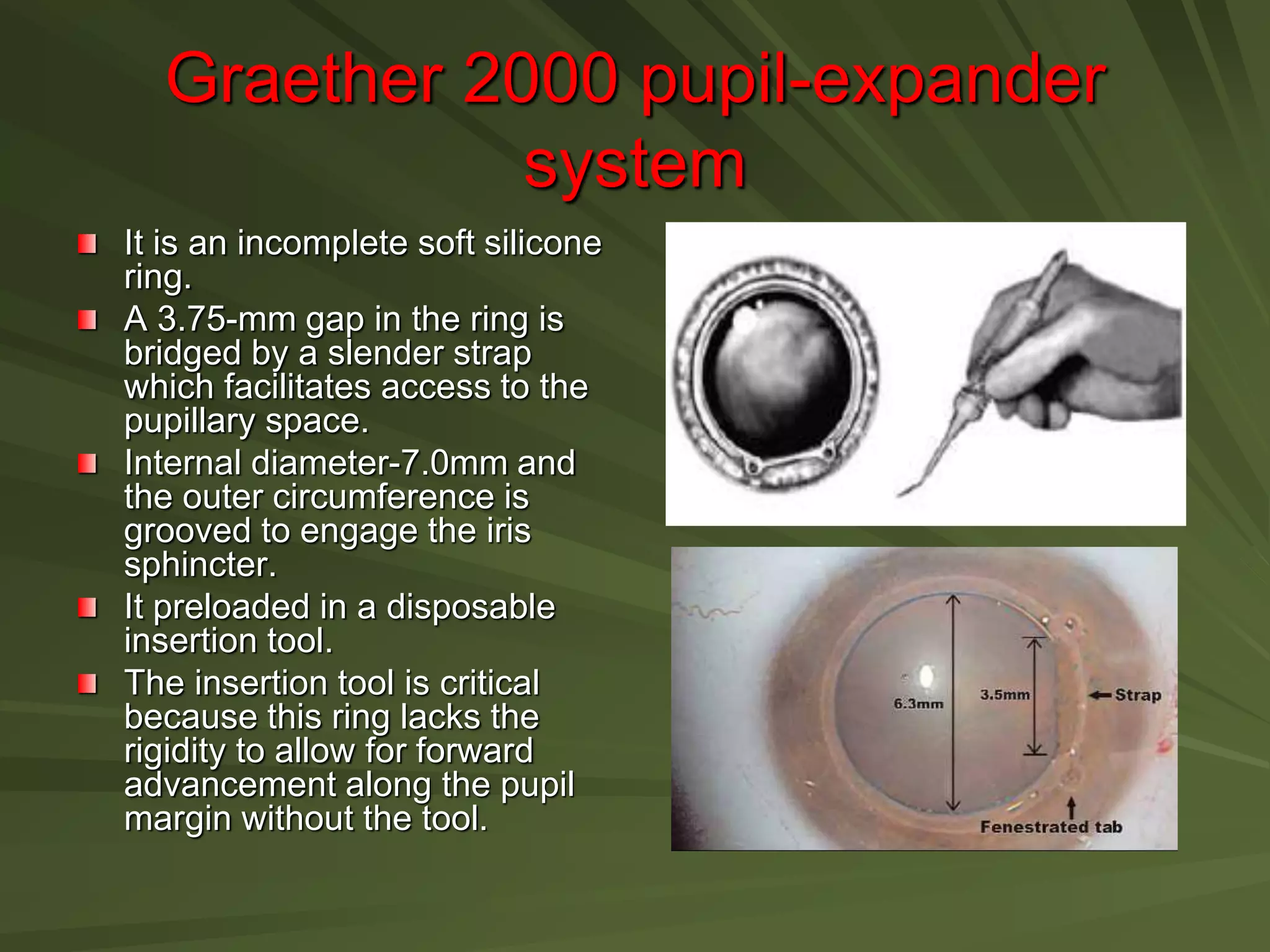 Graether 2000 pupil-expander
system
It is an incomplete soft silicone
ring.
A 3.75-mm gap in the ring is
bridged by a slender strap
which facilitates access to the
pupillary space.
Internal diameter-7.0mm and
the outer circumference is
grooved to engage the iris
sphincter.
It preloaded in a disposable
insertion tool.
The insertion tool is critical
because this ring lacks the
rigidity to allow for forward
advancement along the pupil
margin without the tool.
 