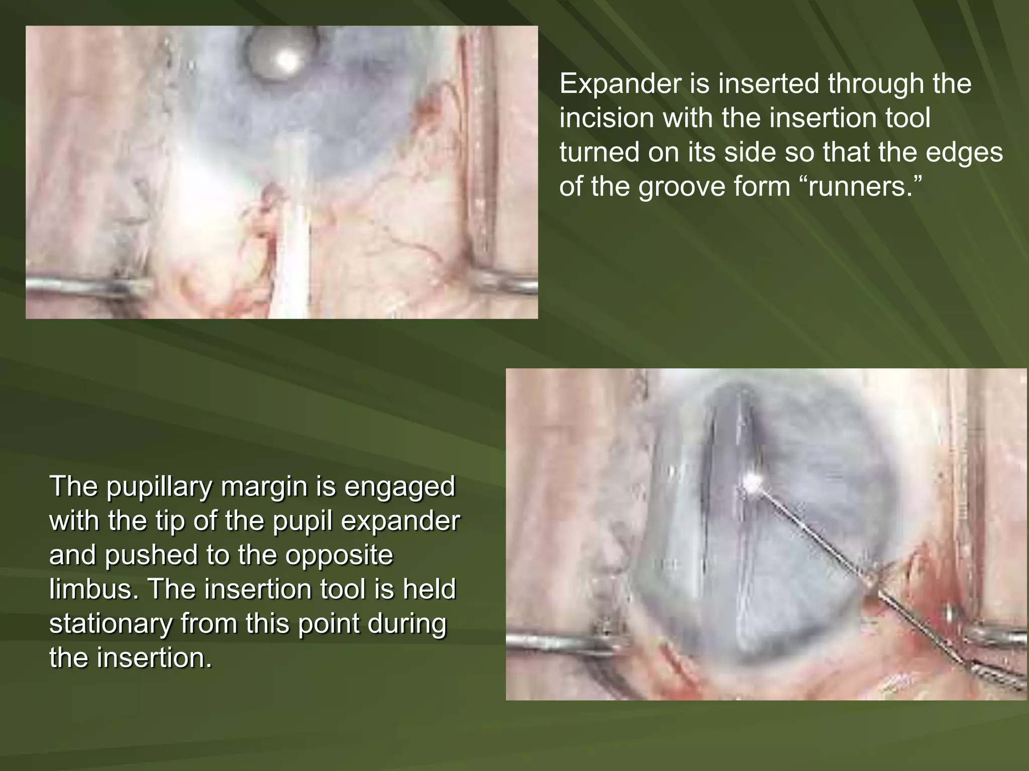 Expander is inserted through the
incision with the insertion tool
turned on its side so that the edges
of the groove form “runners.”
The pupillary margin is engaged
with the tip of the pupil expander
and pushed to the opposite
limbus. The insertion tool is held
stationary from this point during
the insertion.
 