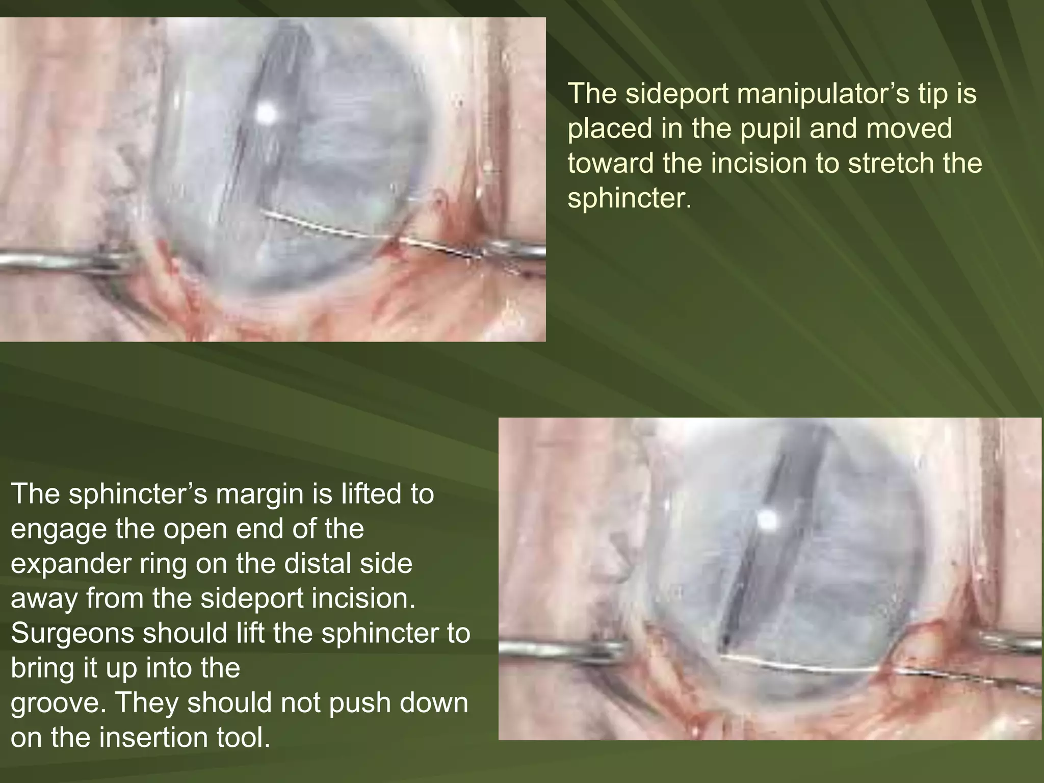 The sideport manipulator’s tip is
placed in the pupil and moved
toward the incision to stretch the
sphincter.
The sphincter’s margin is lifted to
engage the open end of the
expander ring on the distal side
away from the sideport incision.
Surgeons should lift the sphincter to
bring it up into the
groove. They should not push down
on the insertion tool.
 