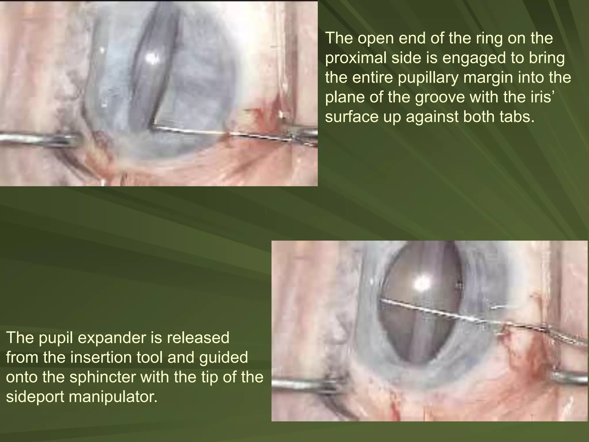 The open end of the ring on the
proximal side is engaged to bring
the entire pupillary margin into the
plane of the groove with the iris’
surface up against both tabs.
The pupil expander is released
from the insertion tool and guided
onto the sphincter with the tip of the
sideport manipulator.
 