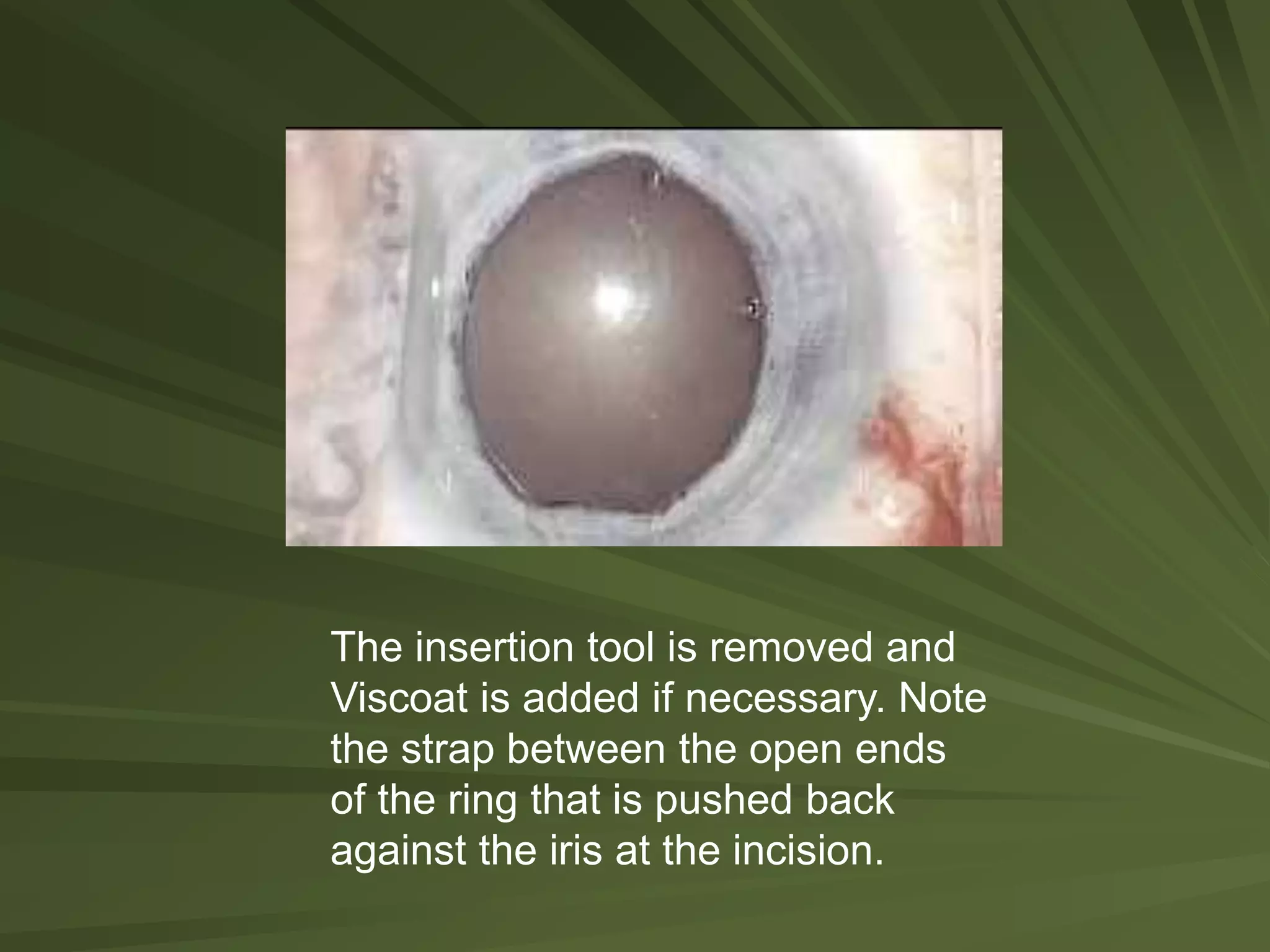 The insertion tool is removed and
Viscoat is added if necessary. Note
the strap between the open ends
of the ring that is pushed back
against the iris at the incision.
 