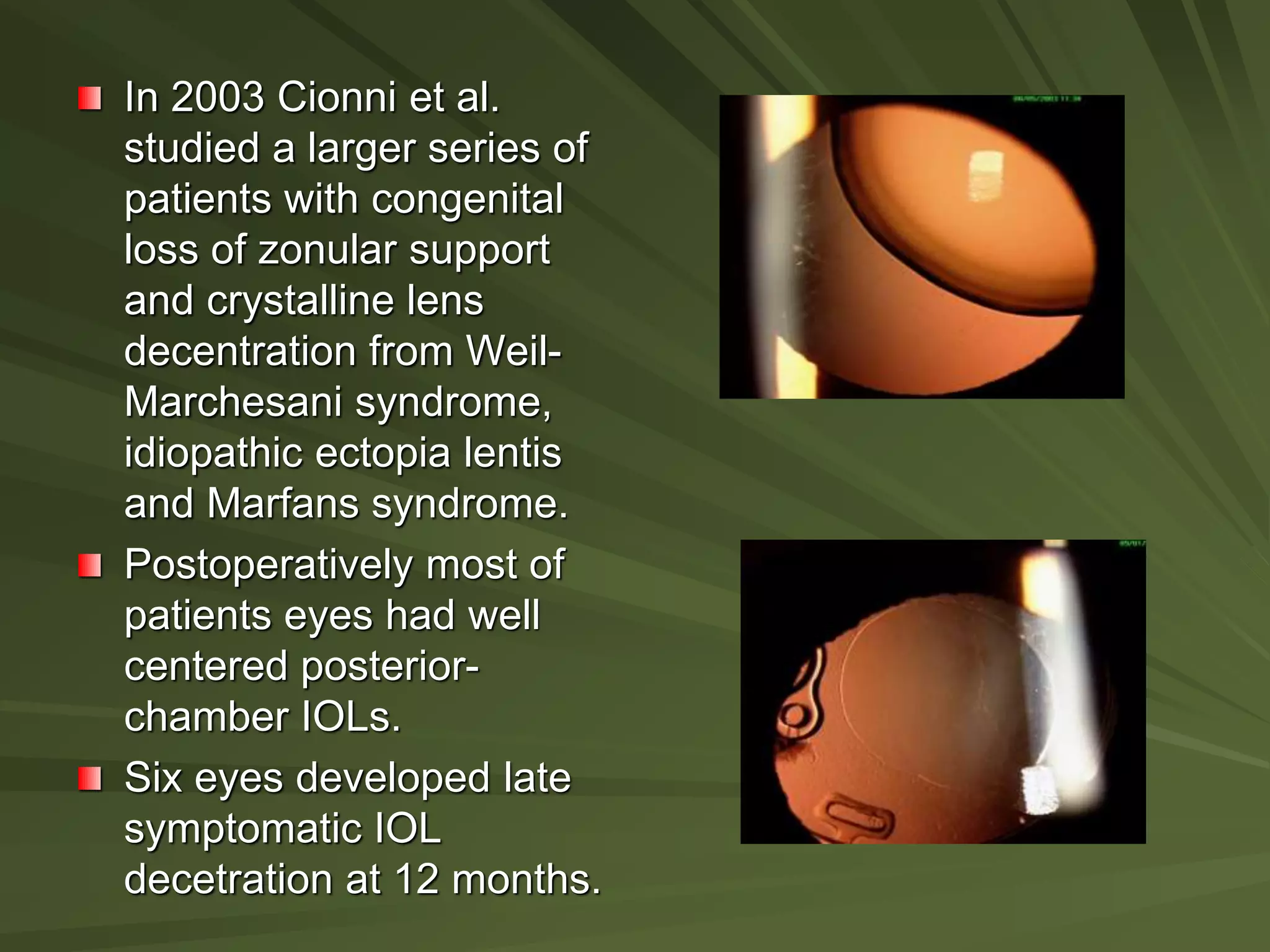 In 2003 Cionni et al.
studied a larger series of
patients with congenital
loss of zonular support
and crystalline lens
decentration from Weil-
Marchesani syndrome,
idiopathic ectopia lentis
and Marfans syndrome.
Postoperatively most of
patients eyes had well
centered posterior-
chamber IOLs.
Six eyes developed late
symptomatic IOL
decetration at 12 months.
 