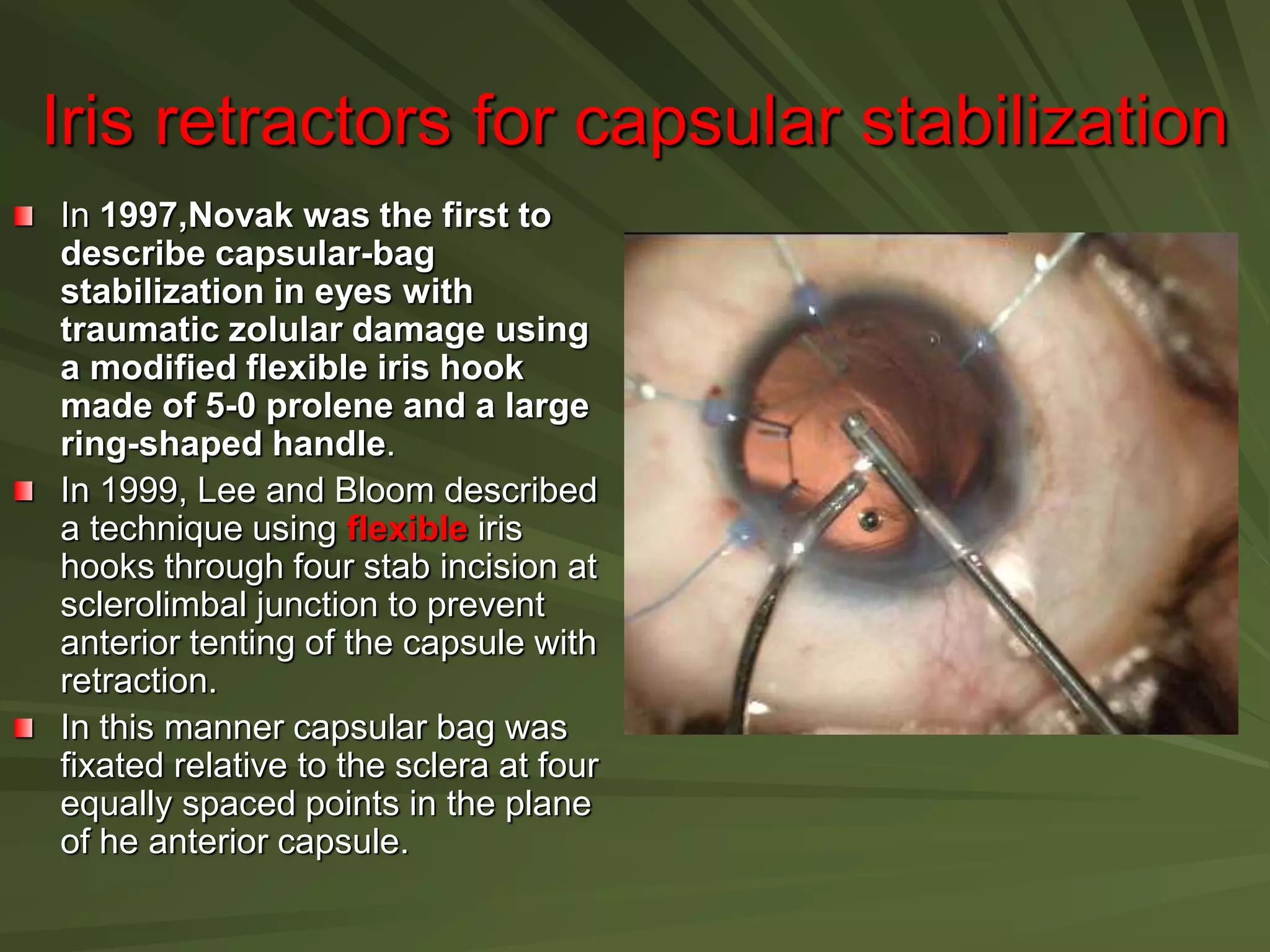 Iris retractors for capsular stabilization
In 1997,Novak was the first to
describe capsular-bag
stabilization in eyes with
traumatic zolular damage using
a modified flexible iris hook
made of 5-0 prolene and a large
ring-shaped handle.
In 1999, Lee and Bloom described
a technique using flexible iris
hooks through four stab incision at
sclerolimbal junction to prevent
anterior tenting of the capsule with
retraction.
In this manner capsular bag was
fixated relative to the sclera at four
equally spaced points in the plane
of he anterior capsule.
 