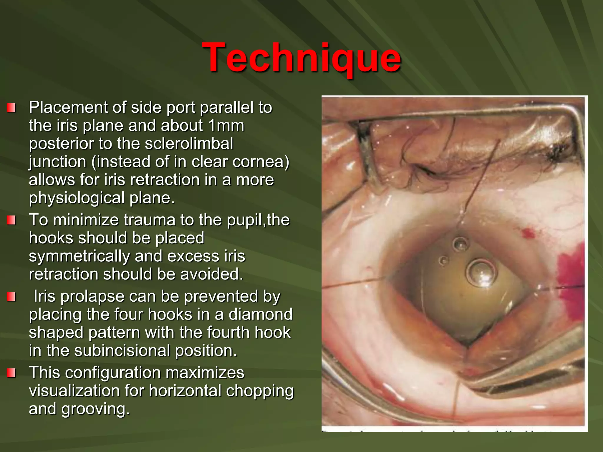 Technique
Placement of side port parallel to
the iris plane and about 1mm
posterior to the sclerolimbal
junction (instead of in clear cornea)
allows for iris retraction in a more
physiological plane.
To minimize trauma to the pupil,the
hooks should be placed
symmetrically and excess iris
retraction should be avoided.
Iris prolapse can be prevented by
placing the four hooks in a diamond
shaped pattern with the fourth hook
in the subincisional position.
This configuration maximizes
visualization for horizontal chopping
and grooving.
 